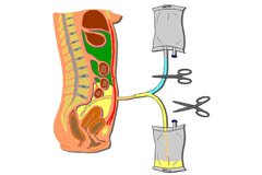 dialyse-peritoneale