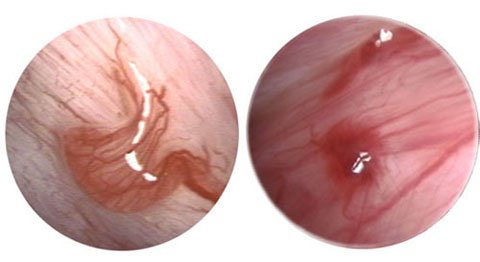 endometriose