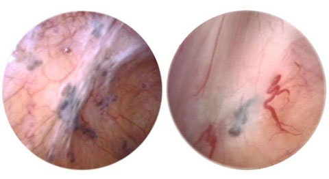 endometriose