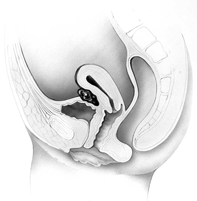 endometriose