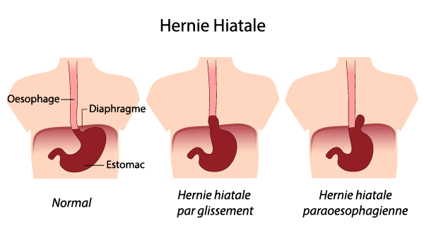 hernie-hiatale